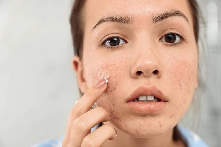 Saiba o que são os adesivos hidrocoloides que ajudam no tratamento da acne