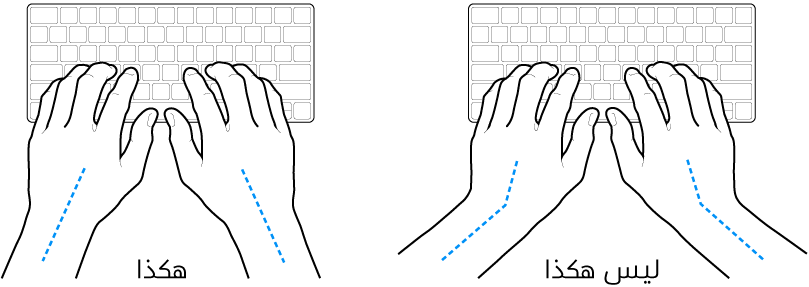 يدان موضوعتان على لوحة مفاتيح، وتظهر المحاذاة الصحيحة وغير الصحيحة للمعصم واليد.