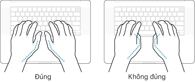 Các bàn tay đặt phía trên bàn phím, minh họa cách đặt ngón cái đúng và sai.