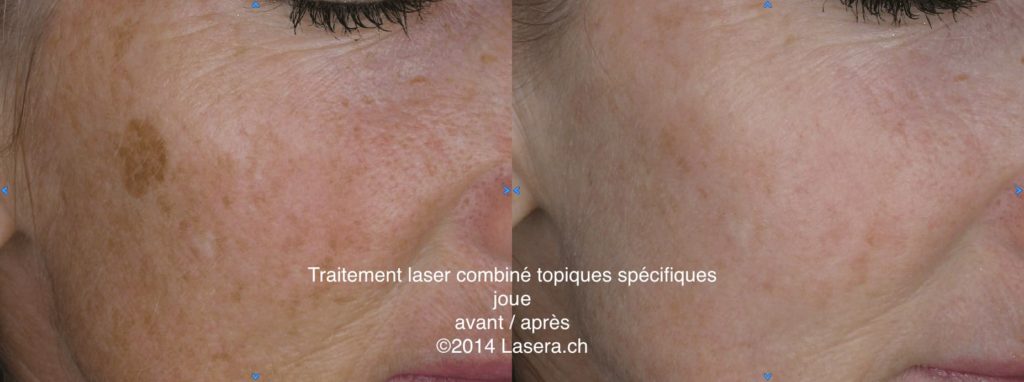 Traitement laser combiné topiques spécifiques - avant / après - joue