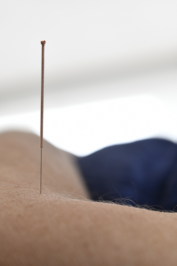 Acupuncture