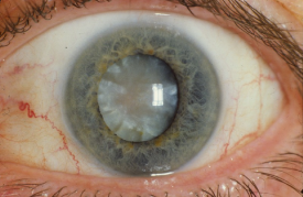 image tagged with cataracts, iris, vision, sclera, eye, …;