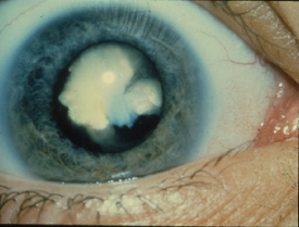 image tagged with congenital cataract, vision loss, vision, cloudy lens, cataracts, …;