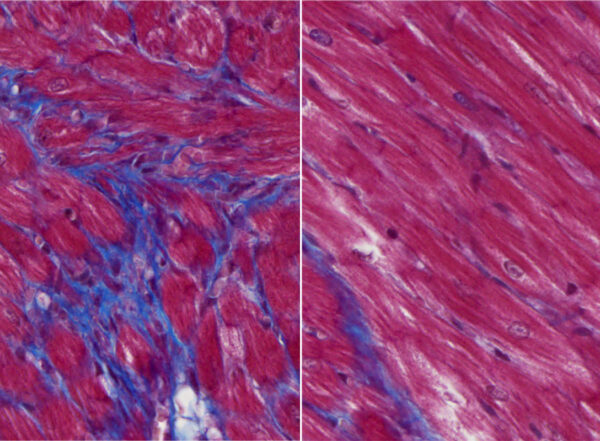 Cardiac tissue from mouse models of heart failure treated with a monoclonal antibody show much less scarring than untreated animals