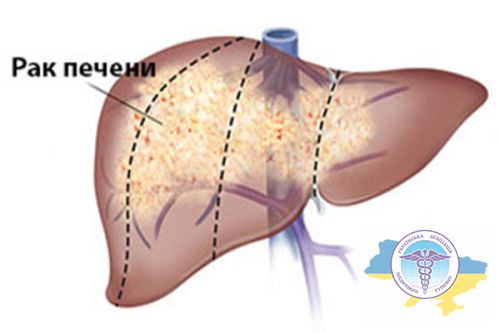 Рак печінки