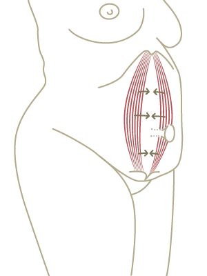 Ablauf Bauchstraffung mit Straffung der Bauchmuskulatur am Nabel