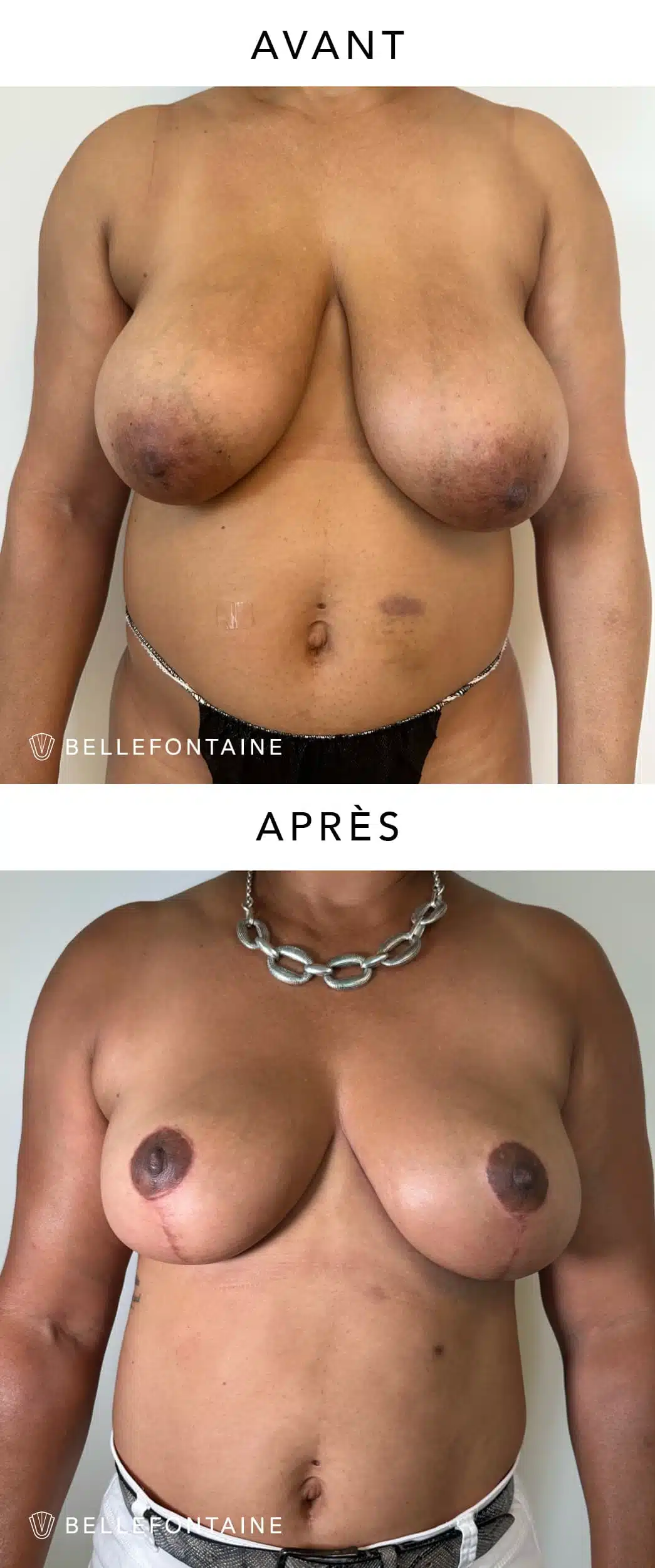 Poitrine de femme de profil face avant/apres reduction mammaire | Dr Favre Lausanne