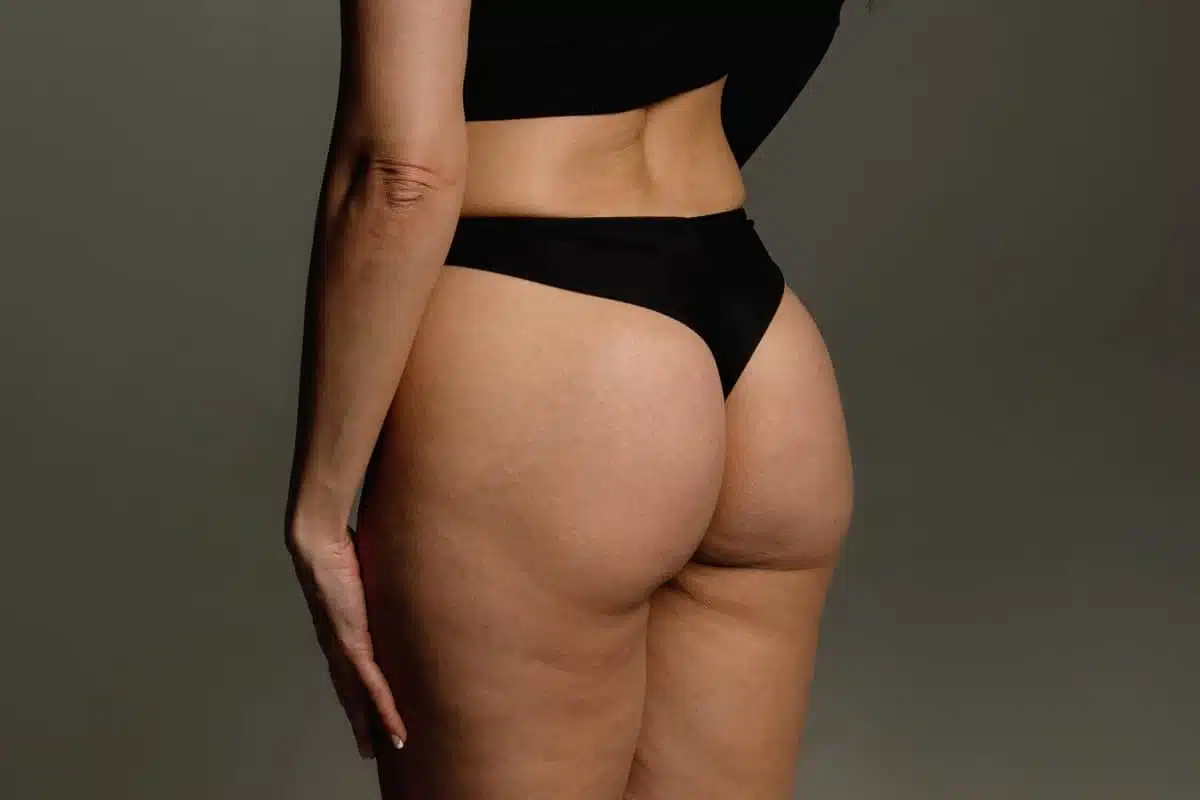 Fesses de femmes avec cellulite liposuccion est elle une solution a la cellulite dr favre Lausane