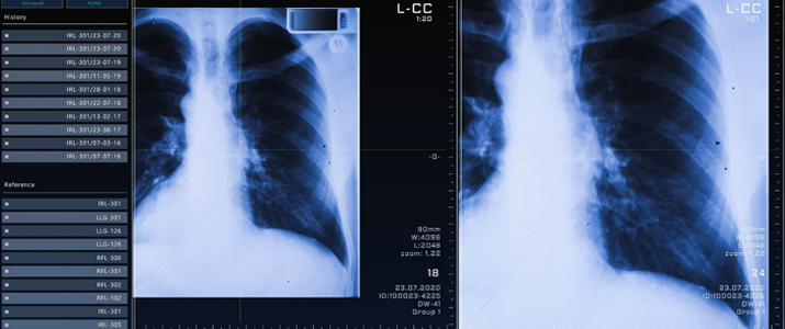 Two CT images of lungs as seen on a computer screen with buttons on the side