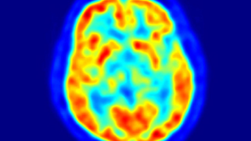 A picture of a PET scan of a brain with red, blue and green.