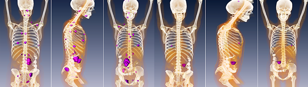 Detection of metastatic paraganglioma with the novel imaging modality 68Ga-DOTATATE PET/CT compared with 18F-FDOPA PET/CT (frontal, lateral, and dorsal views).