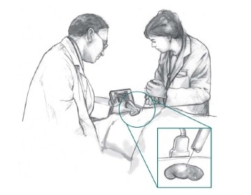 Unos profesionales de atención de salud utilizan la ecografía para guiar una aguja de biopsia a través de la espalda de un paciente acostado sobre una mesa. Un recuadro muestra una vista más cercana de la biopsia de riñón.