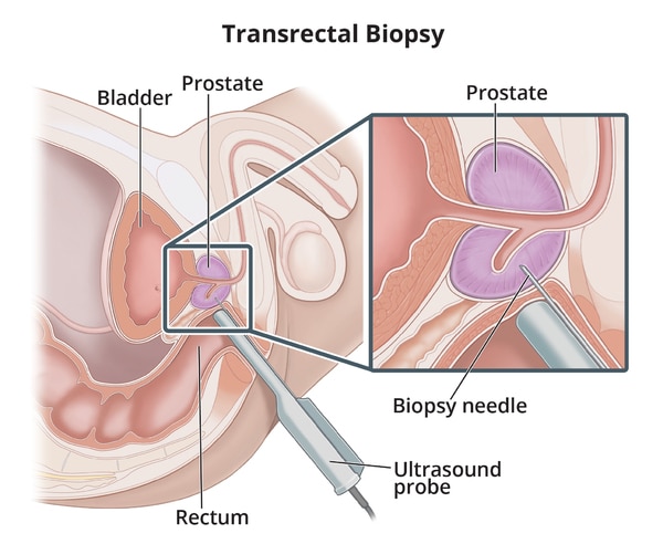 Transrectal biopsy procedure with labeled bladder, prostate, rectum, and ultrasound probe. An inset shows a close-up of the prostate being biopsied. 