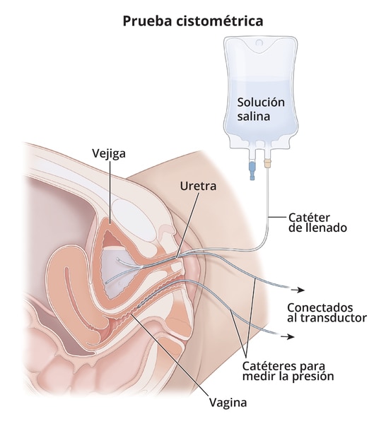 Cystometric test with labeled bladder, urethra, vagina, saline bag, filling catheter, and pressure catheters that connect to the transducer.  