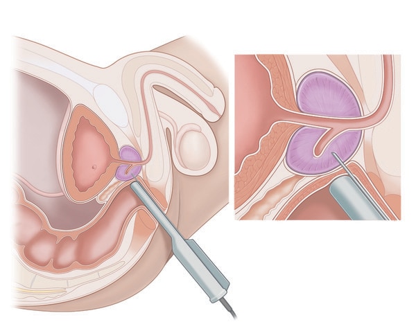 Transrectal biopsy procedure with an inset showing a close-up of the prostate being biopsied. 