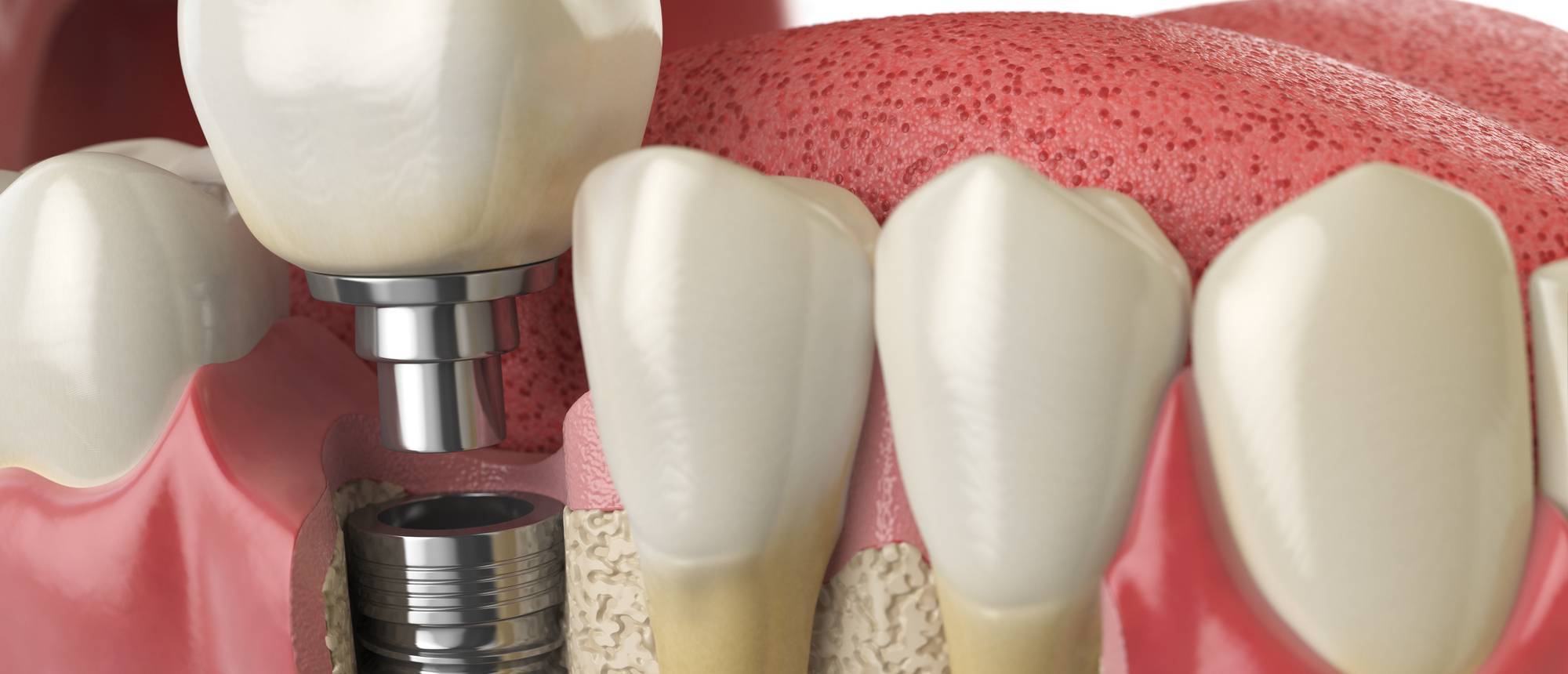 Anatomy of healthy teeth and tooth dental implant in human dentu