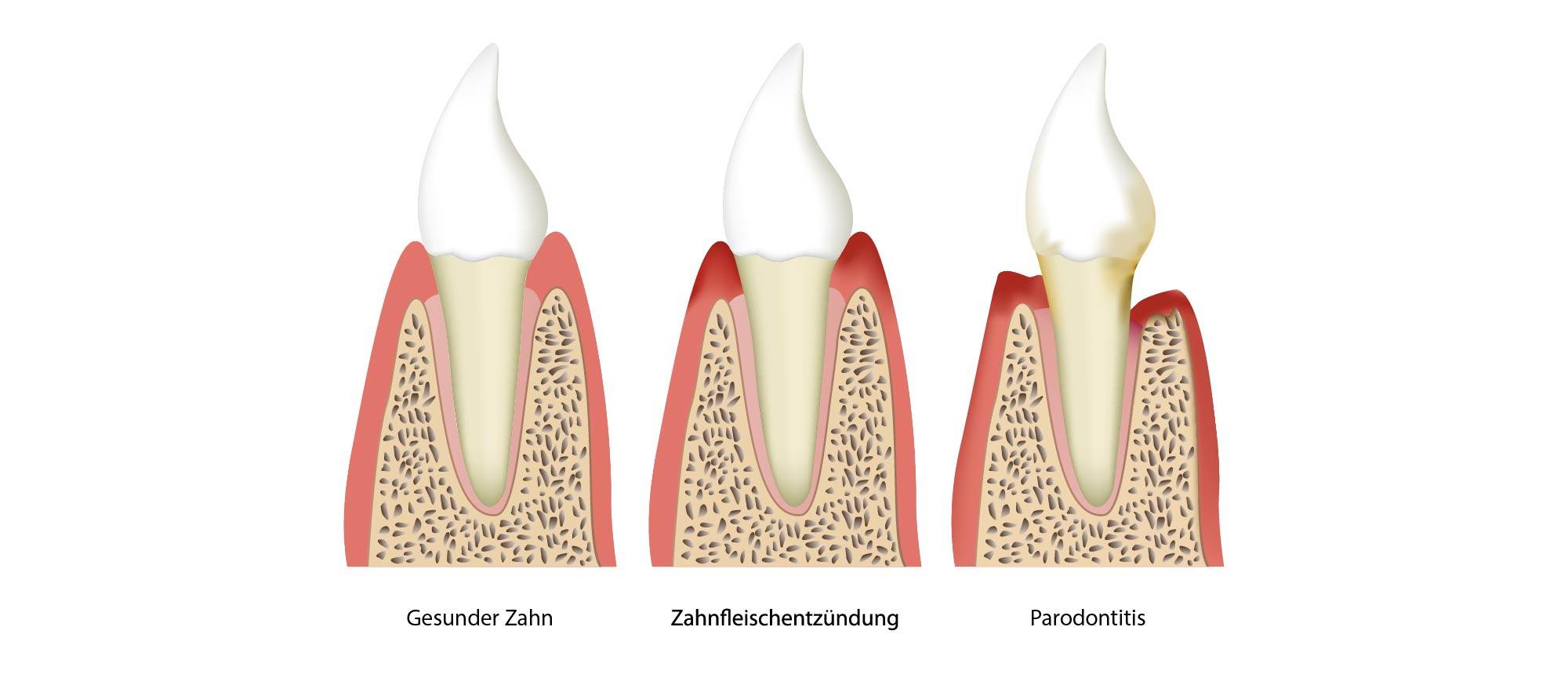 parodontose-zürich